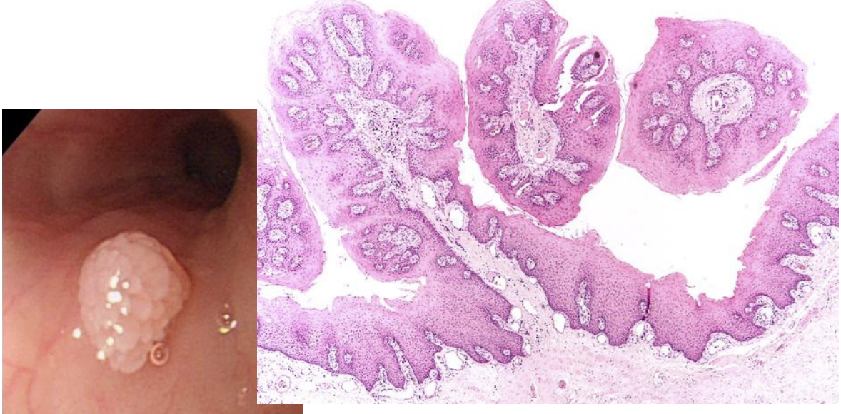 <p>diagnosis, esophageal tumor</p>