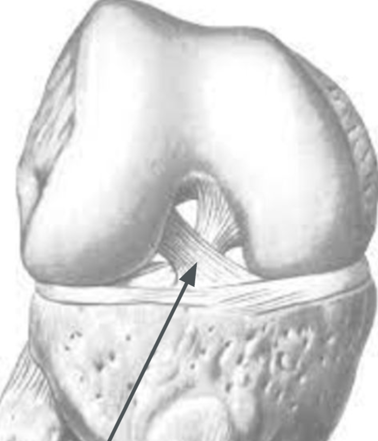 <ul><li><p>Primary anterior stabilizer of the knee</p></li><li><p>3 strands twisted together</p></li><li><p>Attachments:</p><ul><li><p>anterior-medial tibia</p></li><li><p>posterior-lateral femoral condyle</p></li></ul></li><li><p>Prevents anterior displacement of tibia</p></li></ul><p></p>