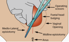 <p>check in sims or side lying to assess, check REEDA and hemorrhoids. encourage ice for 24 hours then heat, peri-bottles and witch hazel/tucks pads, nothing in the vagina until follow up at 6 weeks.</p>