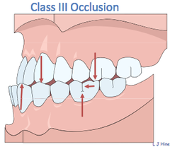 <p>convex (overbite)</p>