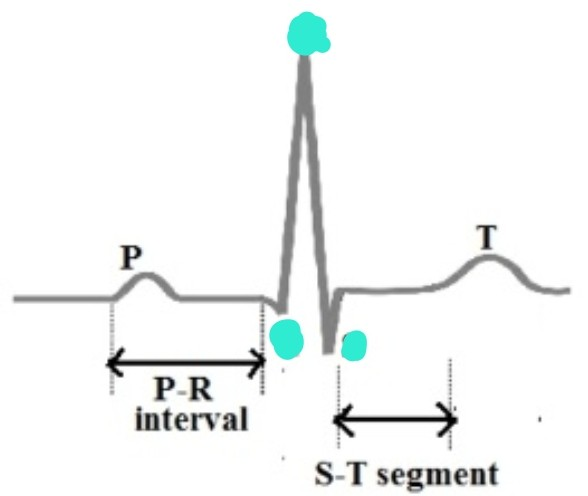 <p>ventricle 수축 시작 부분 뾰족 모양 파형</p>