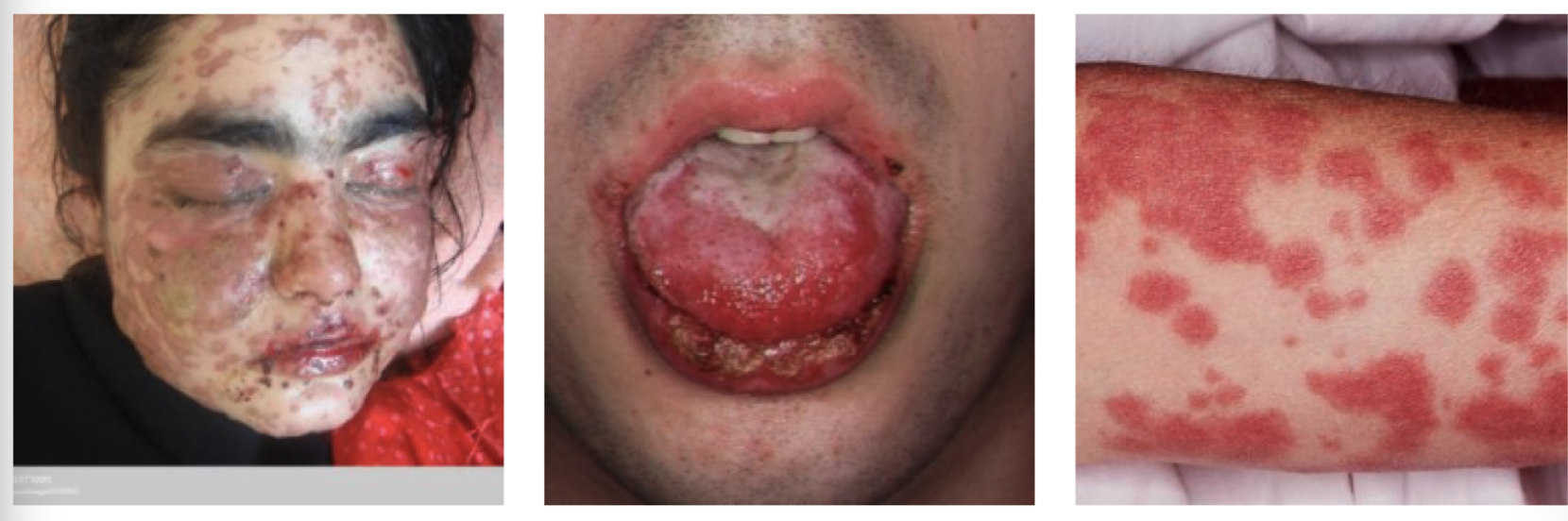 <p>A severe mucocutaneous reaction characterized by <strong>epidermal detachment involving less than 10% </strong>of body surface area.</p>