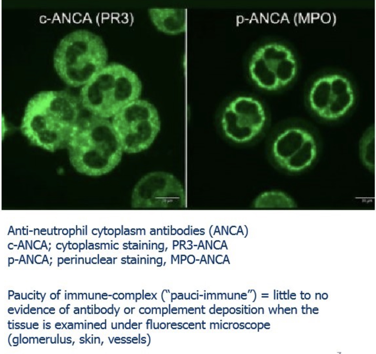 <p>c-ANCA = cytoplasmic staining, targets PR3 (proteinase 3); p-ANCA = perinuclear staining, targets MPO (myeloperoxidase)</p>