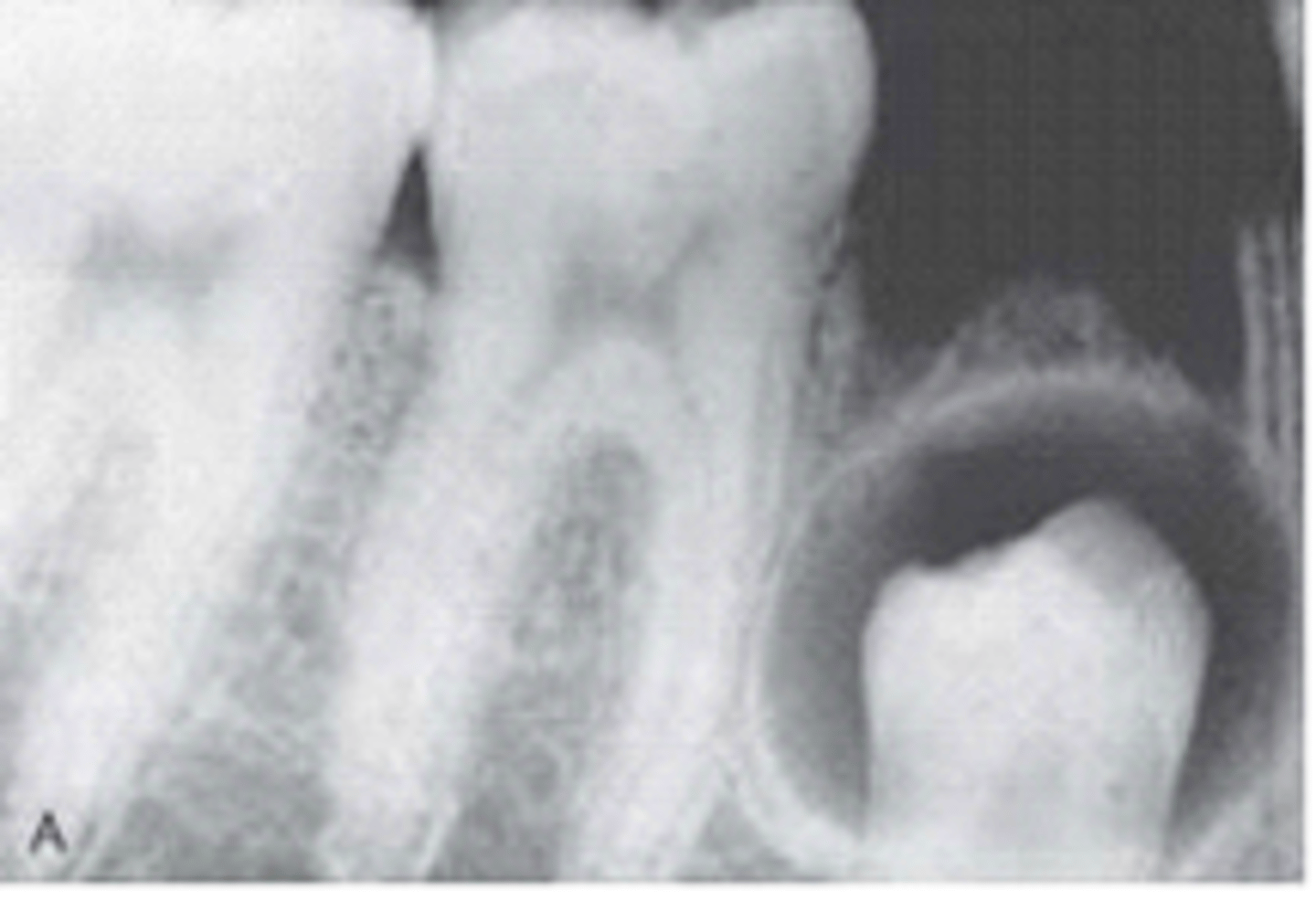 <p>A cyst that forms around the crown of an unerupted or developing tooth. Also called a follicular cyst. Second most common cyst.</p><p><span>This unilocular radiolucency extending CEJ to CEJ around the crown of this unerupted tooth, is most likely a ?</span></p>