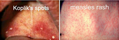 <ul><li><p>-ssRNA virus, paramyxoviridae</p></li><li><p>direct invasion via c. endothelium →<strong> SSPE </strong>(neurodegeneration via latency), maculopapular rash + koplik spots (mouths), <strong>cough, coryza, conjunctivitis</strong></p></li></ul><p></p>