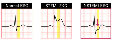 <p>STEMI vs NSTEMI</p>