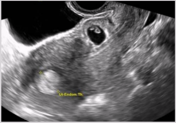 <ul><li><p>Gestational sac implanted into the myometrium</p></li><li><p><span style="background-color: transparent;">Causes: past surgical procedures</span></p><ul><li><p><span style="background-color: transparent;">Ex: myomectomy or C-section</span></p></li></ul></li><li><p><span style="background-color: transparent;">On the rise due to rise of C-section usage</span></p></li></ul><p></p>