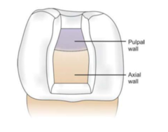 <p>Internal wall: the prepared surfaces of a tooth within a cavity that do not extend to the external tooth surface. They are named based on their orientation relative to the tooth's long axis and the pulp</p><p>Types of Internal Walls:</p><p>Axial Wall: This wall runs parallel to the long axis of the tooth.</p><p>Pulpal Wall: This wall is perpendicular to the long axis of the tooth and is closest to the pulp</p><p>*Walls that are entirely within the tooth preparation</p>