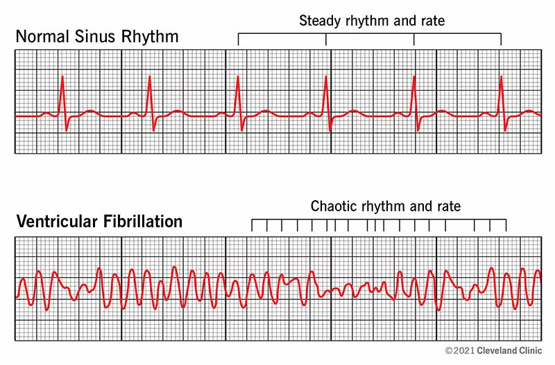 <p>A life-threatening heart rhythm disorder in which the heart’s lower chambers (ventricles) quiver instead of pumping blood effectively.</p>