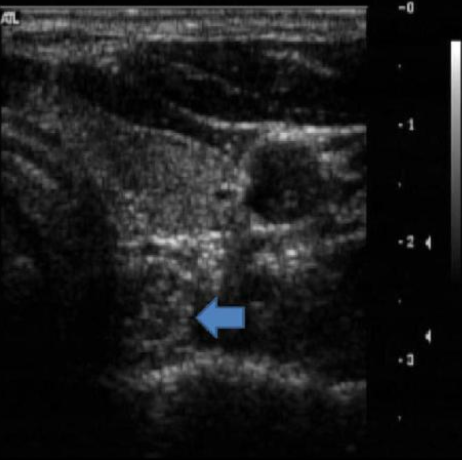 <p>While performing a thyroid ultrasound, you notice the area indicated by the blue arrow. Which of the following statements is true regarding completing the patient’s exam? </p><p>a. color doppler must be applied to assess the tumor’s vascularity</p><p>b. request the patient swallow to better evaluate the area</p><p>c. the radiologist will need all lab values related to the parathyroid hormones and calcium levels in the blood to aid in confirming the diagnosis of the mass</p><p>d. the arrow indicates the normal longus colli muscle</p>
