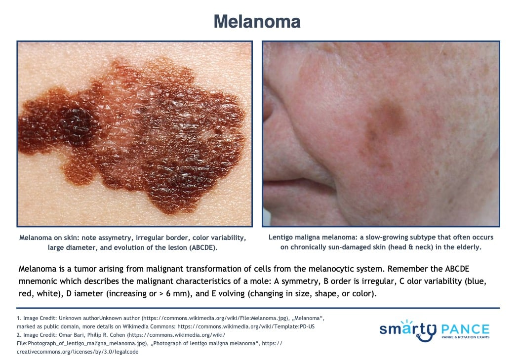 <p>Malignant tumor of melanocytes, which is the deadliest skin cancer</p><p>-RF: UV exposure, fair skin, family history, many nevi</p><p>-Dx: ABCDEs, excisional biopsy is gold standard</p><p>-Tx: wide local excision, node biopsy if > 1mm thickness </p>