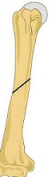 <p>Has a sharp edge which has the most potential to lacerate the radial nerve and profunda brachii artery</p>