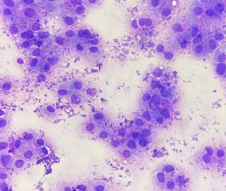 <p>Cytologie parotide</p><p>1) Catégorie selon Milan</p><p>2) Diagnostic</p>