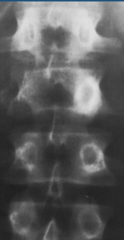 <p>What is this?</p><p>- More sclerotic pedicle</p>