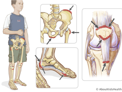 <p>enthesitis </p>