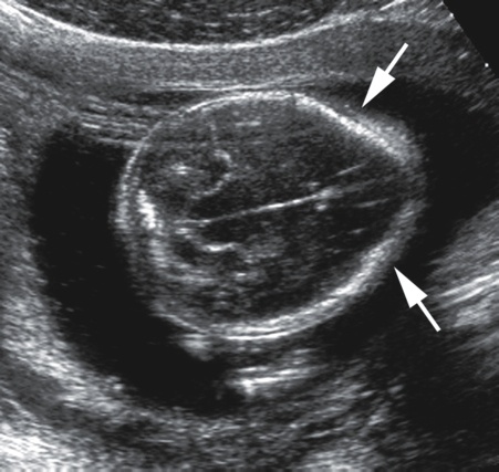 <p>7. What is the sonographic sign indicated by the arrows in Figure 24-34?</p><p>Figure 24-34</p><p>a. Lemon sign</p><p>b. Banana sign</p><p>c. Dangling choroid sign</p><p>d. Pancake sign</p>
