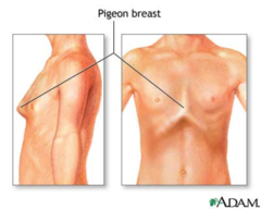 <p>aka pigeon chest</p><p>chest wall condition that causes the breastbone and ribs to push outward</p>