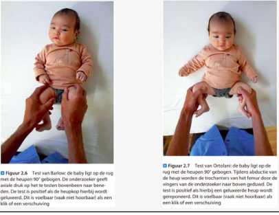 <p>Developmental dysplasia of the hip.</p><p>-Symptomen bij heupluxatie:</p><ul><li><p>extra plooien thv het bovenbeen.</p></li><li><p>Beenlengteverschil.</p></li><li><p>Wanneer er niet wordt ingegrepen zal het kind relatief laat lopen en manken.</p></li></ul><p>-Symptomen bij heupdysplasie:</p><ul><li><p>Weinig symptomen aanwezig.</p></li><li><p>Minder spreidmogelijkheid in de aangedane heup.</p></li><li><p>Echo moet de diagnose bevestigen.</p></li></ul><p>=> Bij pasgeborenen worden tests gedaan om te controleren of het heupgewricht te luxeren is of al geluxeerd staat. Met de handgreep van Ortolani wordt de geluxeerde heup teruggezet en bij de handgreep van Barlow wordt getracht de heup te luxeren. </p><p>De heupen van jonge kinderen zijn geheel kraakbenig en op RX onzichtbaar. Daarom wordt een echo gebruikt om de heup betrouwbaar en veilig na te kijken, zo worden ook de weke delen rond de heup zichtbaar. Na het eerste levensjaar kan het resultaat van de behandeling gevolgd worden met RX’en.</p>