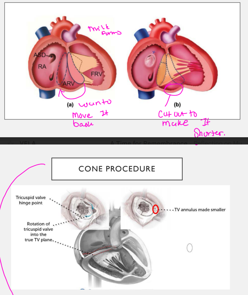<ul><li><p>Smaller leaflets are repaired with Gore-Tex</p></li><li><p>An annuloplasty ring is attached</p></li><li><p>Leaflet tissue is sutured into a cone</p></li><li><p>The atrialized RV is plicated</p></li><li><p>The ASD is closed and excess right atrial tissue is removed</p></li></ul><p><strong>Plicated = folded and stitched down.</strong><br><strong>Atrialized RV plicated = the non-working stretched RV part is folded smaller so the heart shape/function improves.</strong></p>