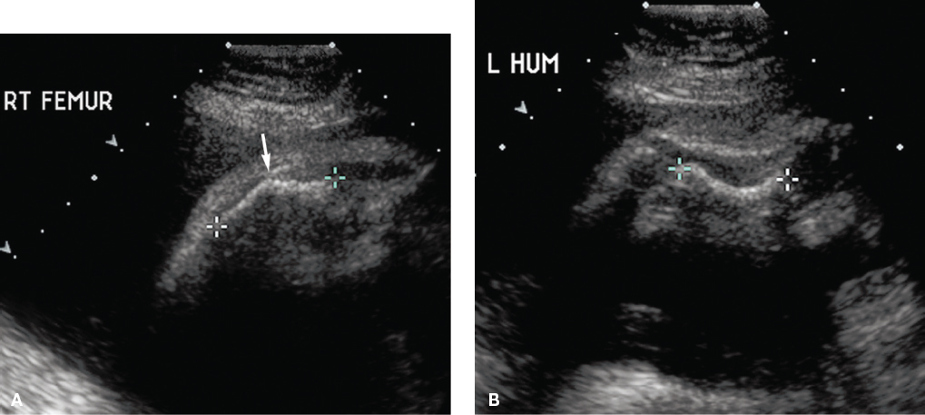 <p>Demineralization of the skull (transducer pressure can alter the shape of the skull)</p><p>Multiple fractures</p><p>Bell-shaped chest</p>