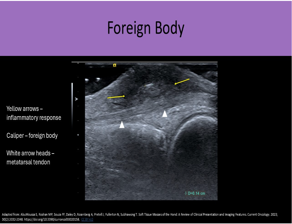 <p>C. Inflammation usually leads to a hypochoic ring surrounding the foreign body.</p><p>MRI is contraindicated for some types of foreign bodies (metallic). Most foreign bodies present as an echogenic structure with some degree of posterior shadowing. Inflammation usually leads to a hypochoic ring surrounding the foreign body. Improved visualization of the foreign body occurs as the US beam becomes more perpendicular to the structure.</p>
