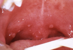<p>Acute enteroviral vesicular disease.</p>