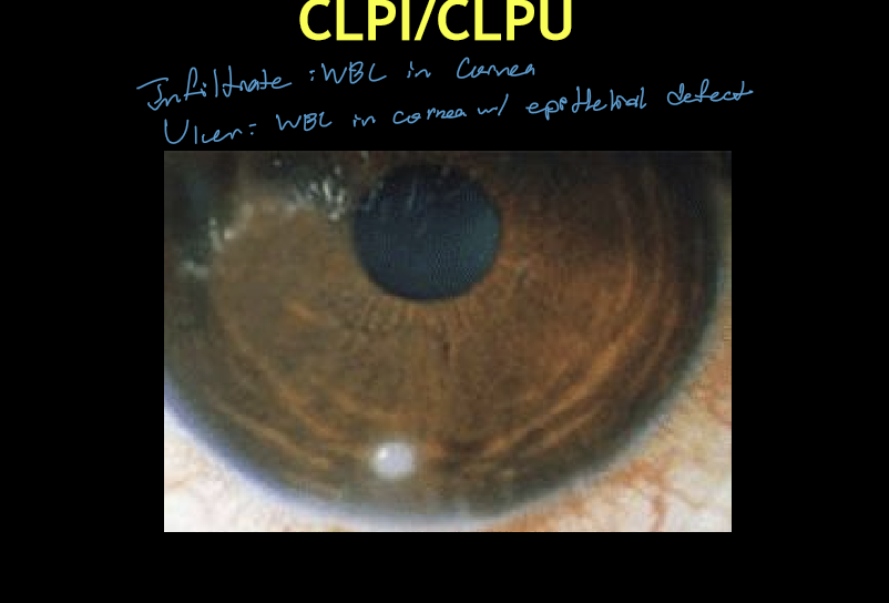 <ul><li><p>Usually unilateral</p></li><li><p>Single, circular, well‑defined focal infiltrate</p></li><li><p>Size: ≤ 2 mm</p></li><li><p>Location: peripheral cornea just inside the limbus</p></li><li><p>CLPI: no fluorescein staining</p></li><li><p>CLPU: positive staining (epithelial defect)</p></li></ul><p></p>