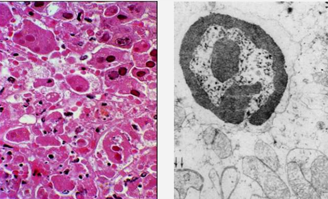 <ul><li><p>chromatinas sutrūkinėja ir tankėja, nyksta be pėdsako</p></li></ul><p></p>