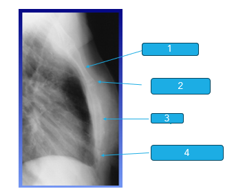 <p>What is 3 on this sternum?</p>