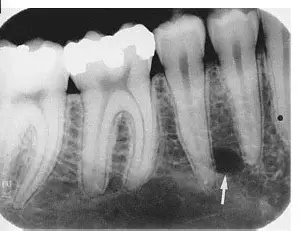 <p>what colour is the pulp and hard tissue (enamel)</p>