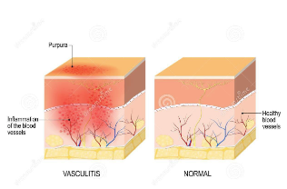 <ul><li><p>red-purple lesions that do not blanch</p></li><li><p>cause: blood forced from the vessel into surrounding tissue</p></li></ul><p></p>