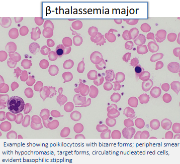 <ul><li><p>loss of both B chains (B0/B0)</p></li><li><p>severe transfusion-dependent anemia → associated 2ndary hemosiderosis + hemochromatosis organ damage (heart, endo, liver, pancreas)</p></li><li><p>marked hemolysis, <u>erythroid hyperplasia w/ marrow expansion</u> + extramedullary hematopoiesis → cortical bone remodel (maxillary, frontal facial) + organomegaly</p></li><li><p>peripheral smear → marked anisocytosis, poikilocytosis, microcytosis, hypochromia, target cell, basophilic stippling, fragmented red cell, nucleated red cell (poorly hemoglobinized) </p></li></ul><p></p>
