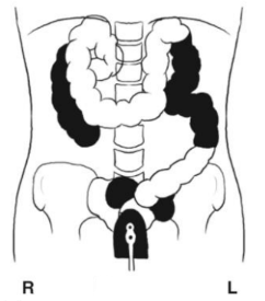 <p>What position is the patient in? Air = black. Barium = white</p>