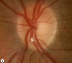 <p>Calcific</p>