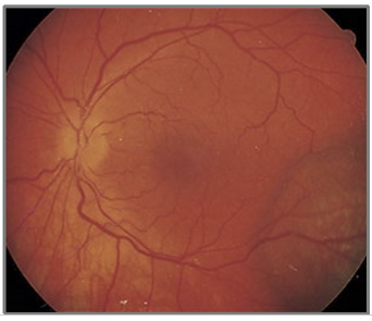 <p>In children < 2 years old, retinal hemorrhages should raise strong concern for nonaccidental trauma (abuse).</p>
