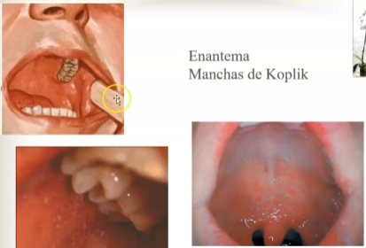 <p>Enantema de Manchas de Koplik</p>
