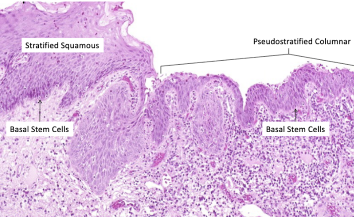 <p><strong>Altered differentiation</strong> of cells, usually in response to chronic inflammation</p>
