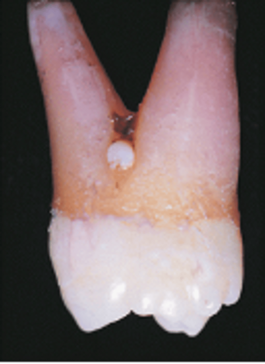<p><br>-Ectopic enamel</p><p>-Tooth enamel on the root surface (usually in the furcation)</p><p><span>What is the white, spherical enamel projection located at the furca of the tooth in the image called?</span></p>