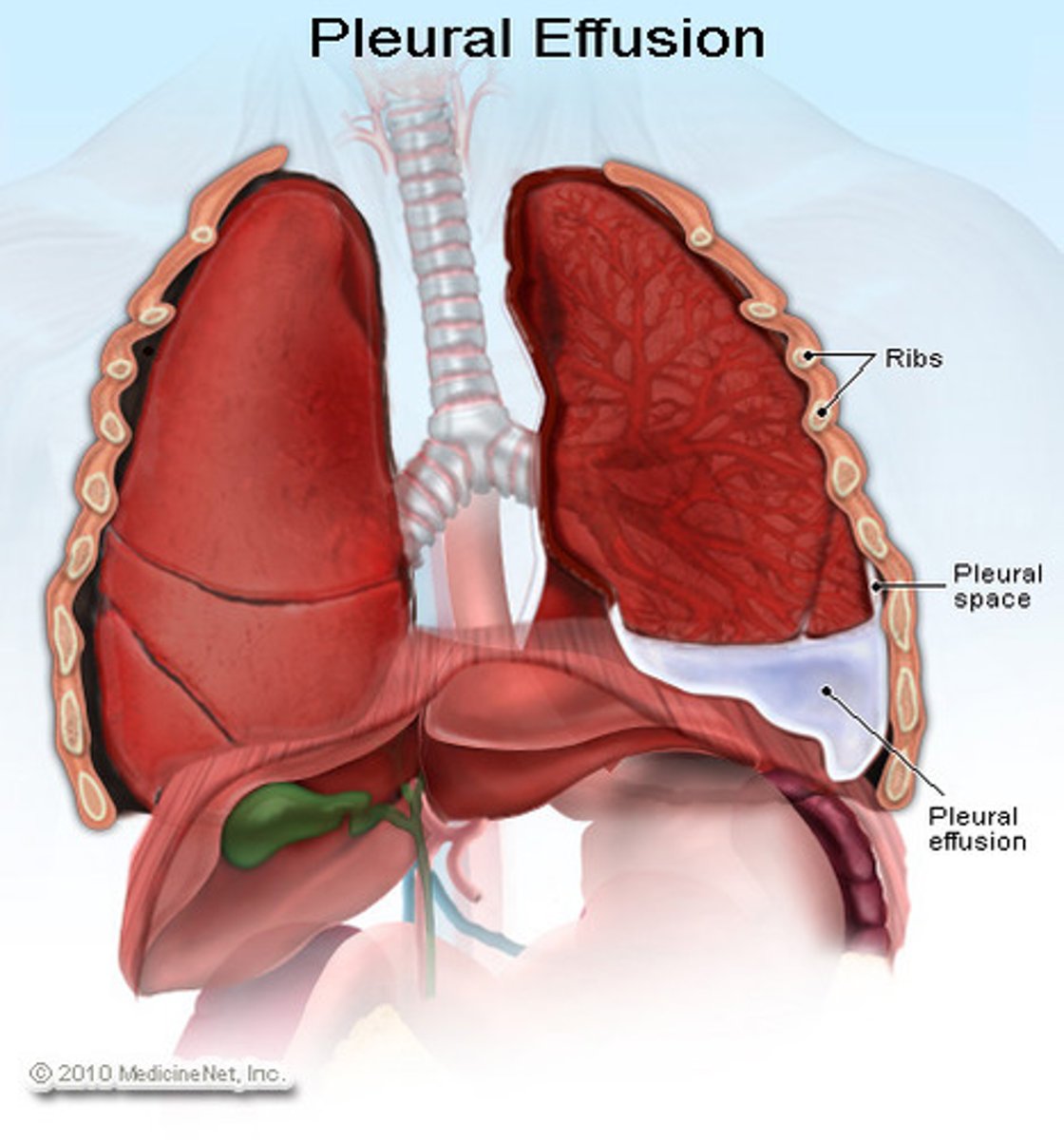 <p>pleural effusion</p>
