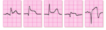 <p>what does this EKG show? </p>