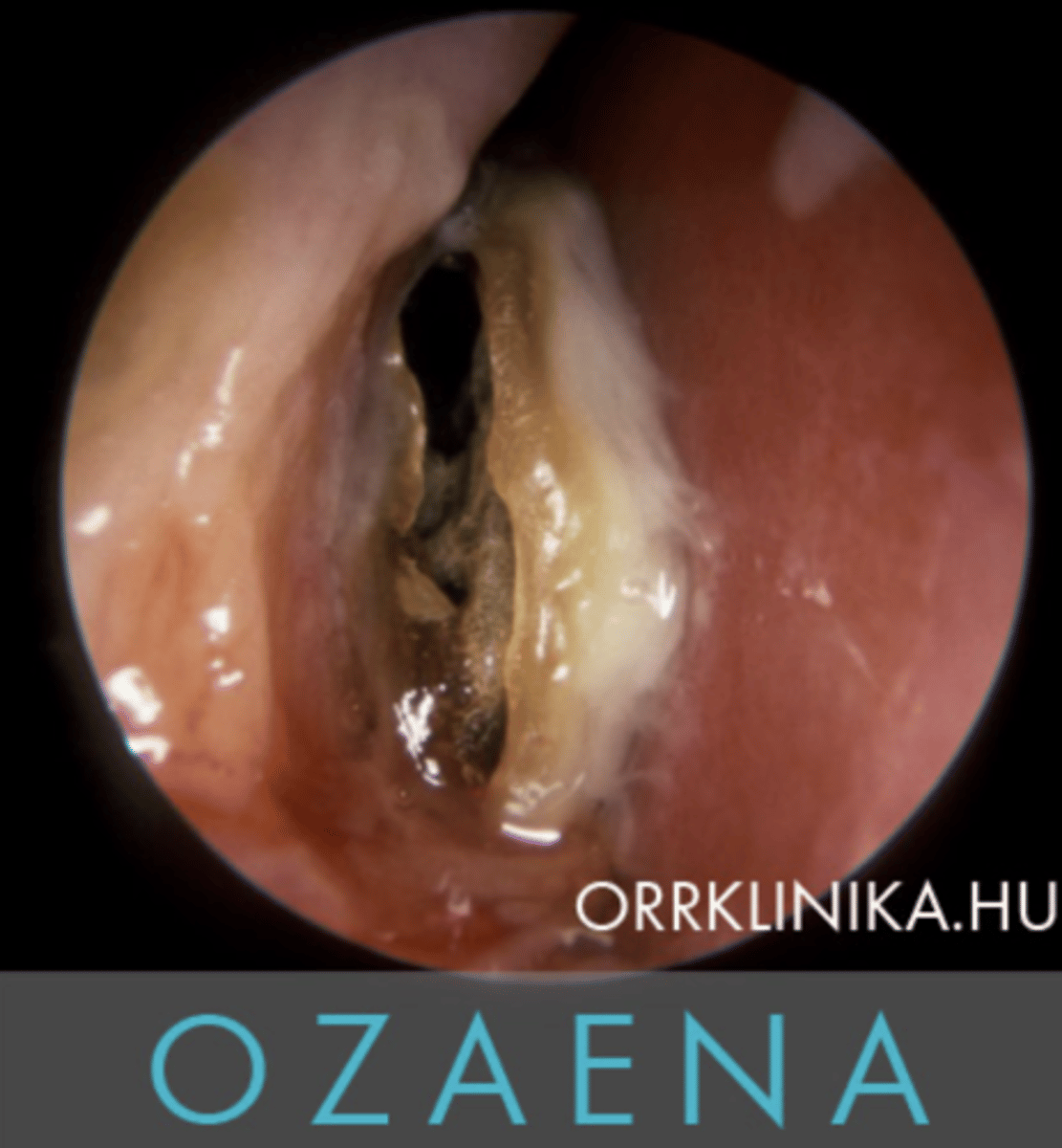 <p>E) is characterized by all the above statements</p><p>EXPLANATION</p><p>Atrophic oezema is characterized by a foul smelling fluid, where it’s etiology is unknown and is shown to be improving with aging.</p>