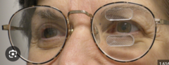 <p>For a right hemianopsia, two 40 diopter fresnel prism segments are placed BO over the right lens</p><p>For a left hemianopsia, two 40 diopter Fresnel prism segments are placed BO over the left lens. Esch segment is placed 7mm above and 7mm bellow the midline of the pupil. This allows for about 20 degrees of filed expansion (40*0.57). </p><p>This is different from placing base right prism over both eyes for a right hemianopsia, which is not field expansion at all. This causes a shift in the visual field for patients with a midline shift or hemi filed neglect.</p>