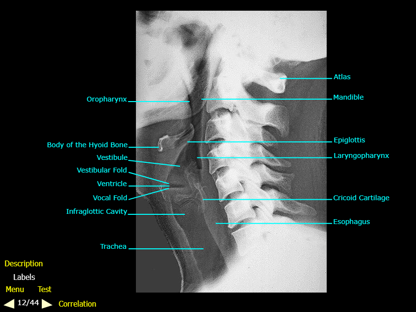 <ol><li><p>Oropharynx</p></li><li><p>Body of the Hyoid bone</p></li><li><p>Vestibule</p></li></ol><p></p>