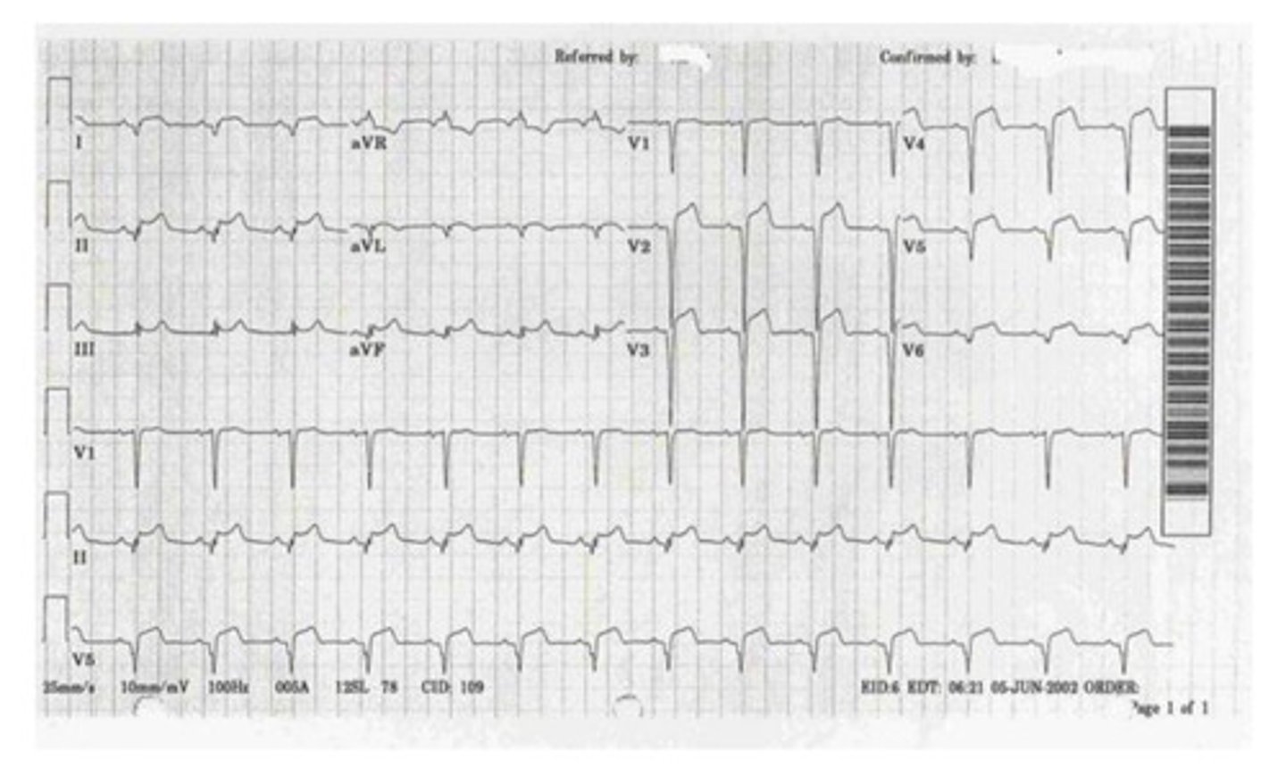 <p>this is an example of _____, which has a key characteristic of diffuse ___ elevation</p>