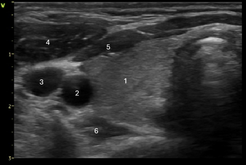 <p>Which of the following structures is labeled #6?</p><p>A. Longus Colli muscle</p><p class="p1">B. Sternocleidomastoid muscle</p><p class="p1">C. Strap muscle</p><p class="p1">D. Esophagus</p>