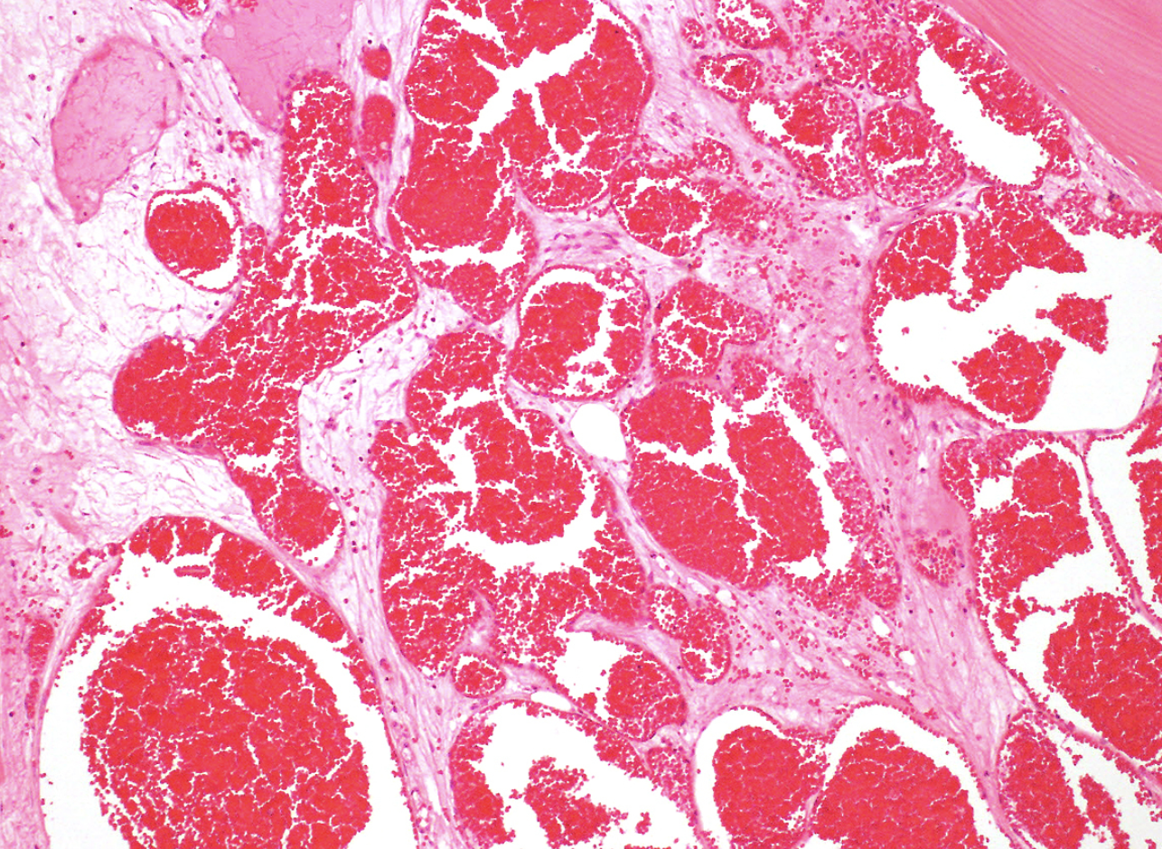 <p>tumeur du corps vertébral</p><p>diagnostic</p><p>anatomie</p><p>histologie</p><p>IHC </p><p></p>