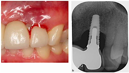 <p><span>Peri-implant bone loss in conjunction with soft tissue inflammation</span></p>