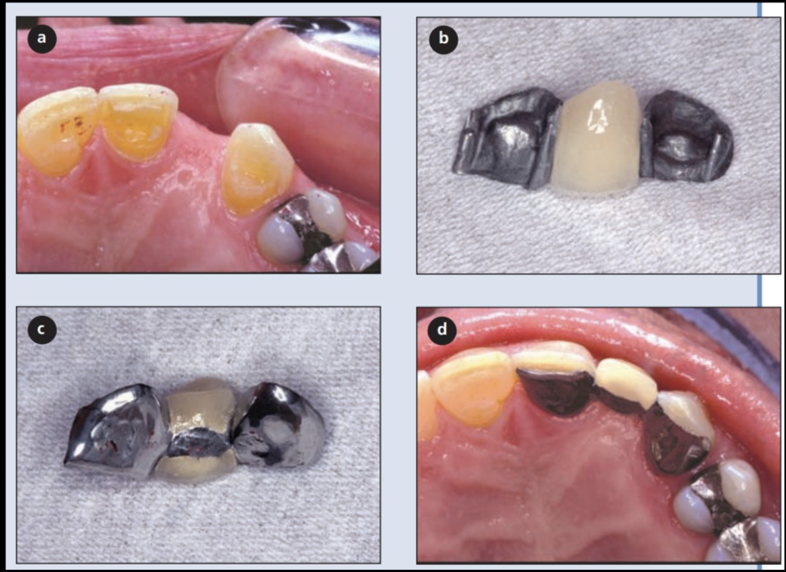 <p>what is the major problem w these restorations </p>