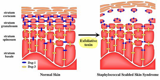 <p>staphylococcus aureus 표피탈락독소 exfoliative toxins</p>