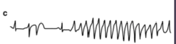 <p>What is Torsades de Pointes?</p>